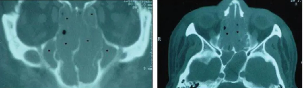 Gambar 3.2  CT scan NHL sinus paranasal  9