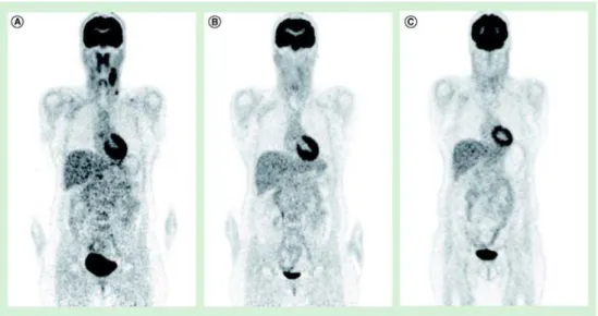 Gambar 3.4  Evaluasi terapi limfoma dengan PET Scan  13   