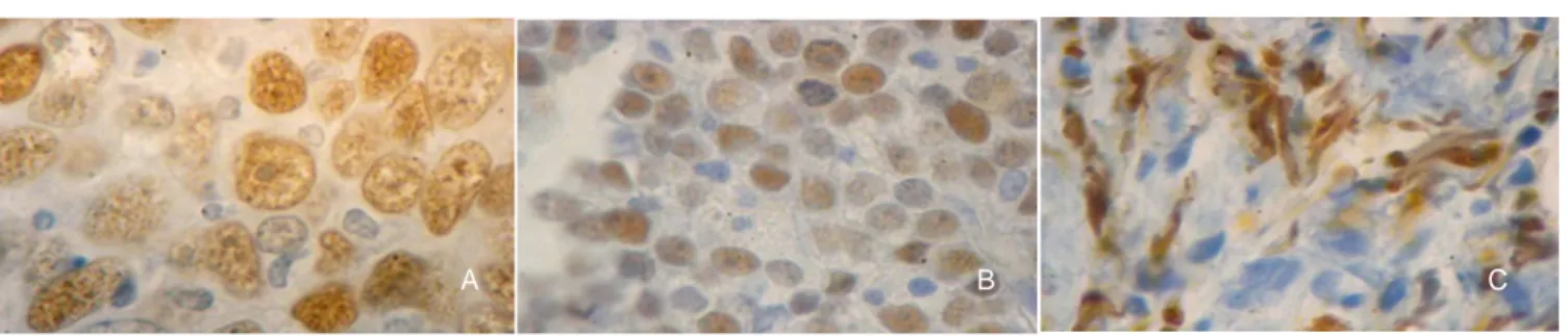 Gambar 2. Pulasan Ki67, Pembesaran asli 100x, A. sentroblastik, B. imunoblastik, dan C