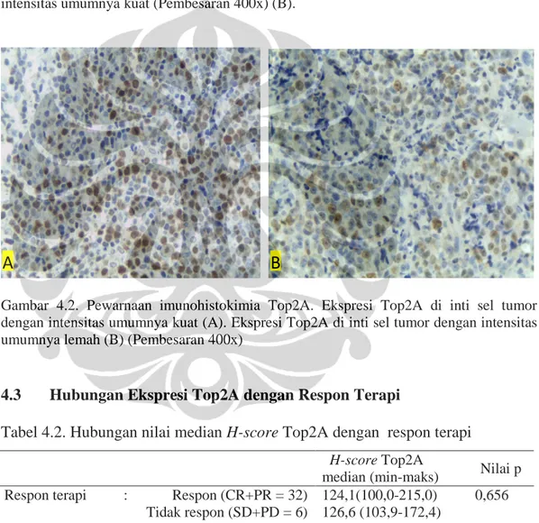 Gambar  4.2.  Pewarnaan  imunohistokimia  Top2A.  Ekspresi  Top2A  di  inti  sel  tumor  dengan intensitas umumnya kuat (A)