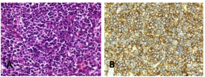 Gambar 2. Pewarnaan Top2A. Ekspresi Top2A di inti  sel  tumor  dengan  intensitas  umumnya  kuat  (A)