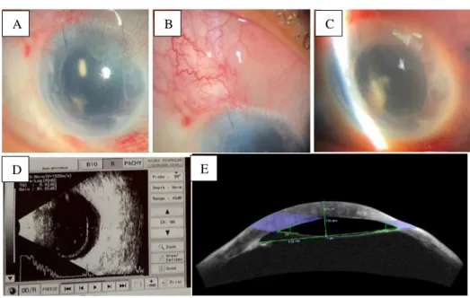 Gambar 5. Pemeriksaan oftalmologis hari ketujuh setelah operasi. (A) Tampak PC   IOL.  (B)  Bleb  overfiltrasi  (C)  BMD  dangkal
