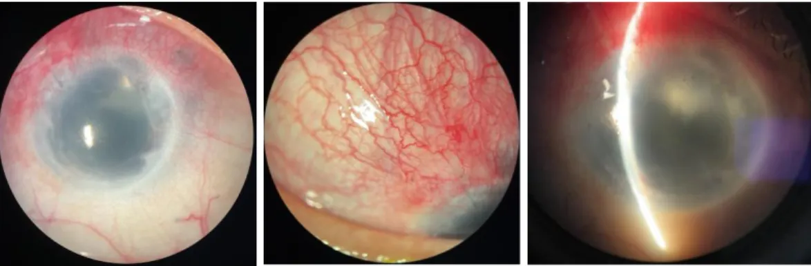 Gambar 6. Pemeriksaan oftalmologis minggu ke-2 setelah operasi. (A) Tampak PC   IOL. (B) Bleb datar (C) BMD dangkal
