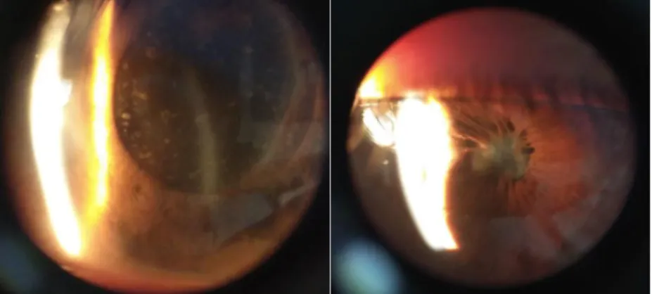 Gambar 2.1  Pemeriksaan segmen anterior (A) mata kanan dan (B) mata kiri  Sumber : RS mata Cicendo 