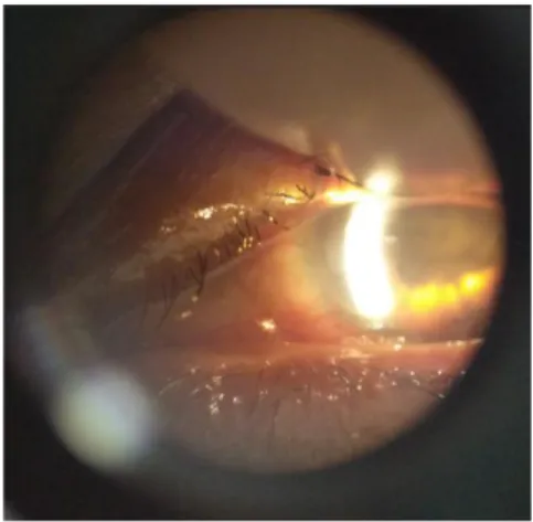 Gambar 2.2 Pemerikasaan segmen anterior mata kiri 1 hari post operasi  Sumber : RS Mata Cicendo 