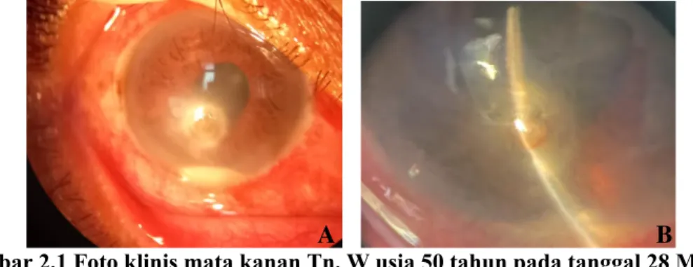 Gambar 2.2 Pemeriksaan USG mata kanan pasien Tn. W pada tanggal 28 Mei 2021  A.  Kesan suspek detasemen vitreus posterior komplit  