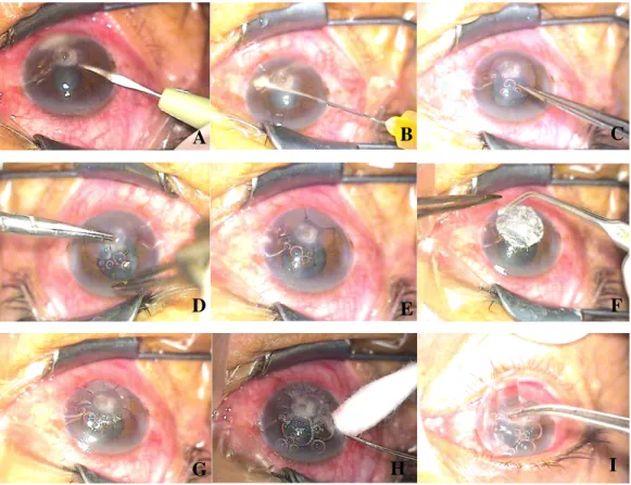 Gambar 2.3 Intraoperasi mata kanan Tn. W usia 50 tahun tanggal 2 Juni 2021  Gambar  (A)  pembentukan  side  port  pada  arah  jam  11;  gambar  (B)  washout  bilik  mata  depan  dan  pengambilan  sampel  infiltrat  dan  hipopion; gambar (C), (D), dan (E) p