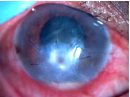 Gambar 2.5 Foto klinis mata kanan Tn. W usia 50 tahun pada tanggal 23 Juni 2021          Segmen anterior mata kanan tiga minggu pasca operasi 