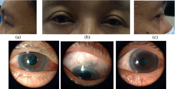 Gambar 2.1 Foto klinis mata kiri pasien tanggal 3 Juni 2021 