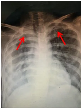 Gambar 1 Rontgen Thoraks. Kedua tanda panah menunjukan bagian apex paru yang terdapat  peningkatan corakan bronkovaskular yang mengindikasikan infeksi TB paru 