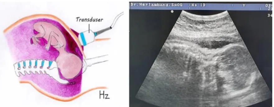 Gambar 3.5 Pencitraan USG transabdominal (bidang sagital) pada janin  dengan posisi oksiput anterior