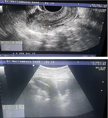 Gambar 3.12 Gambaran uterus normal pada pemeriksaan transvaginal 