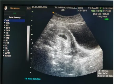 Gambar 4.2 Kehamilan intra uterin normal pada usia kehamilan 5 minggu  yang dicitrakan menggunakan metode transabdomen 