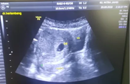 Gambar 4.6 Kehamilan awal tampak uterus dengan kantong kehamilan dan  vesika urinaria 