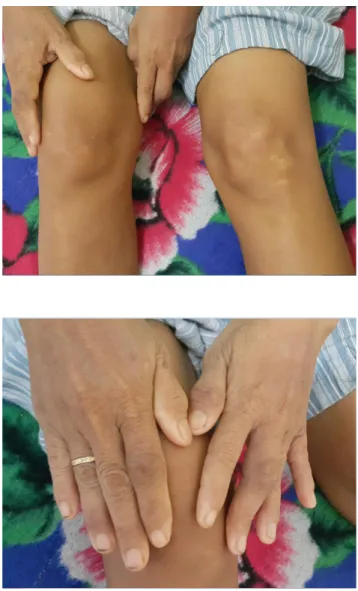 Foto klinis jari-jari tangan dan lutut pasien 