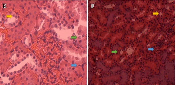 Gambar 3. Gambaran histopatologi ginjal tikus perlakuan III  pada hari ke-7(E) dan hari ke 14(F) dengan  pembesaran 400x terlihat adanya sel yang mengalami degenerasi (tanda panah kuning), infiltrasi sel radang  (tanda panah biru), nekrosis (tanda panah hi