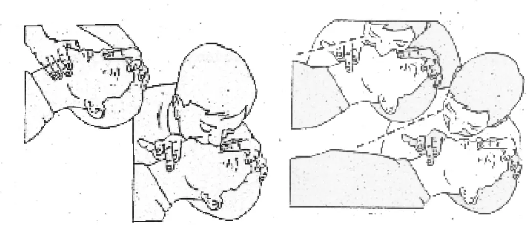 Gambar  4.: Pelaksanaan Pernapasan dari Mulut ke Mulut (Sumber: Youngson 1997:6-7)