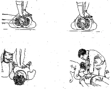Gambar 5.: Pelaksanaan Kompresi Jantung Luar (Sumber: Arthur 1986: 387-388)