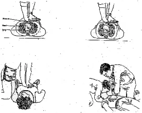 Gambar 5.: Pelaksanaan Kompresi Jantung Luar (Sumber: Arthur 1986: 387-388)