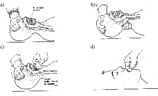 Gambar 1. : Pelaksanaan Tripple Airway Manuever  (Sumber: Arthur E.E., 1986: 376-378)