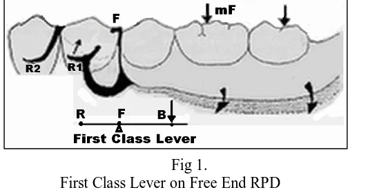 Fig 1.                         First Class Lever on Free End RPD 