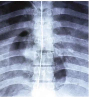 Gambar 3. Foto thoraks dengan gambaran distensi radiolusen pada ruang kanan jantung  yang menandakan emboli udara