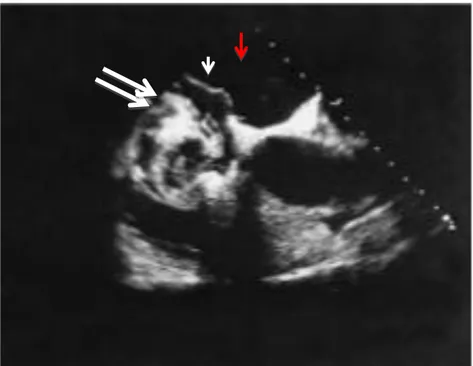 Gambar 2. Ekokardiogram transesofageal dari pasien dengan paten foramen  ovale. Cairan saline disuntikkan dengan cepat melalui kateter vena sentral
