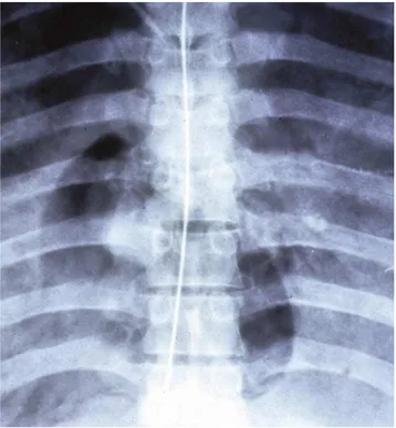 Gambar 3. Foto thoraks dengan gambaran distensi radiolusen pada ruang kanan  jantung  yang menandakan emboli udara  