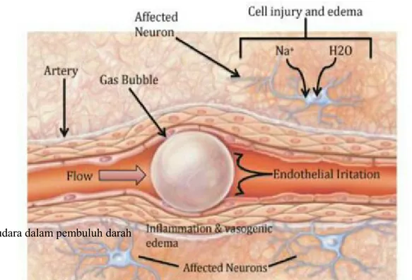 Gambar 3. Emboli udara dalam pembuluh darah 8