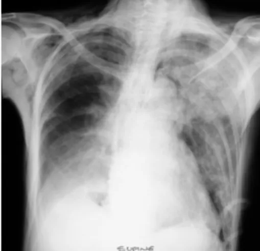 Gambar  2.9 :  Radiografi  dada  pada   seorang laki-laki  dengan  trauma  dada tumpul terlihat perdarahan pada lobus atas paru kiri, dan emfisema