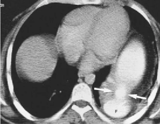 Gambar 2.15: Ruptur Diafragma.   B:  CT scan menunjukkan  collar  sign (panah).  Fundus (F) di posisi posterior 4