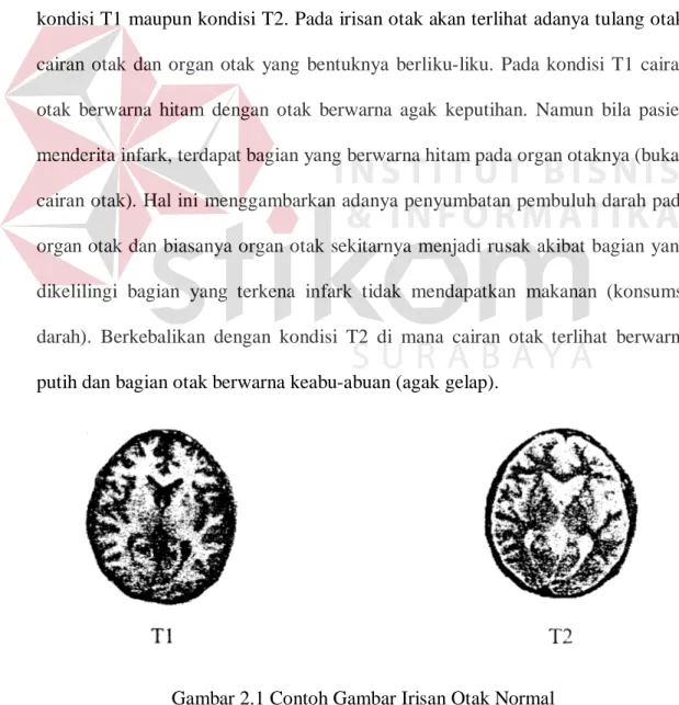 Gambar 2.1 Contoh Gambar Irisan Otak Normal 