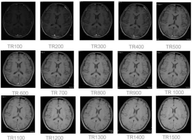 Gambar 2. MRI brain potongan axial sequence T1  SE 