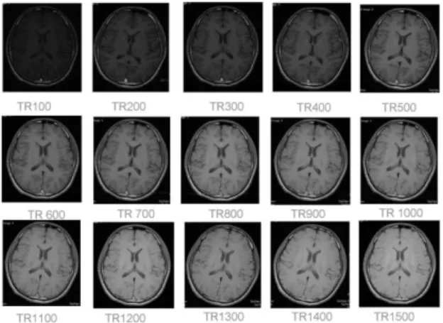 Gambar 2. MRI brain potongan axial sequence T1  SE 