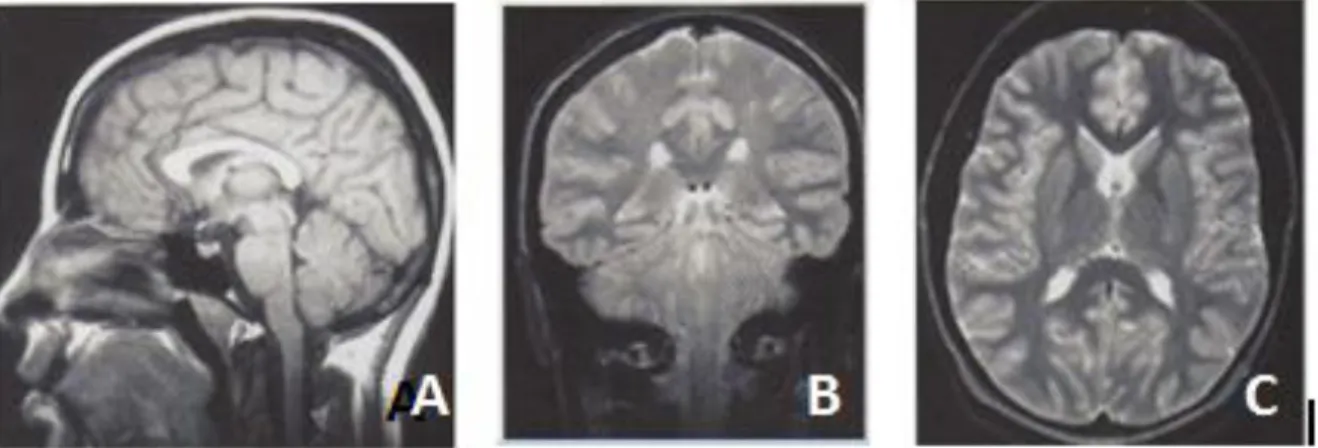 Gambar 1.  Citra MRI Brain: A. Sagital B. Coronal C. Axial   (Bontrager dan Lampignano, 2005) 