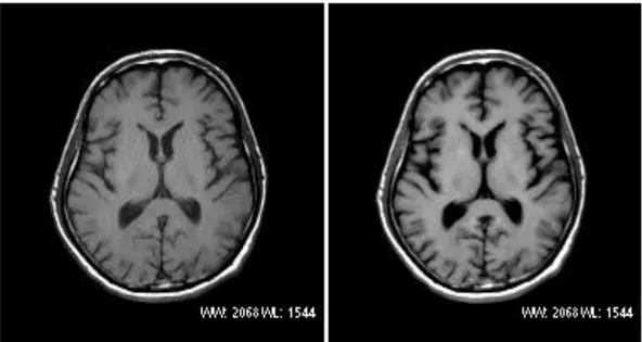 Gambar 3.  (A) Citra MRI brain axial sequence T1 SE dan (B) T1 FLAIR 