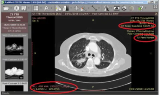 Gambar 2.CT scan paru kasus tumor paru kanan  2.2. Algoritma Segentasi Pendeteksian Nodul  