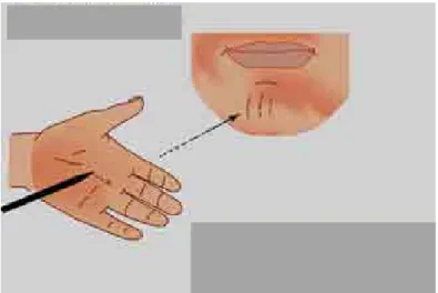 Gambar 4. Glabellar reflex  5.  Snout Reflex 