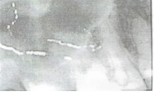 Gambar 9: Foramen mentale  Terlihat  gambaran  radiolusen  dengan  batas  yang  tegas  pada  apeks  gigi  premolar  satu  bawah