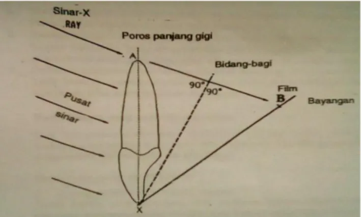 Gambar 2.1. Teknik biseksi (Margono, 1998). 