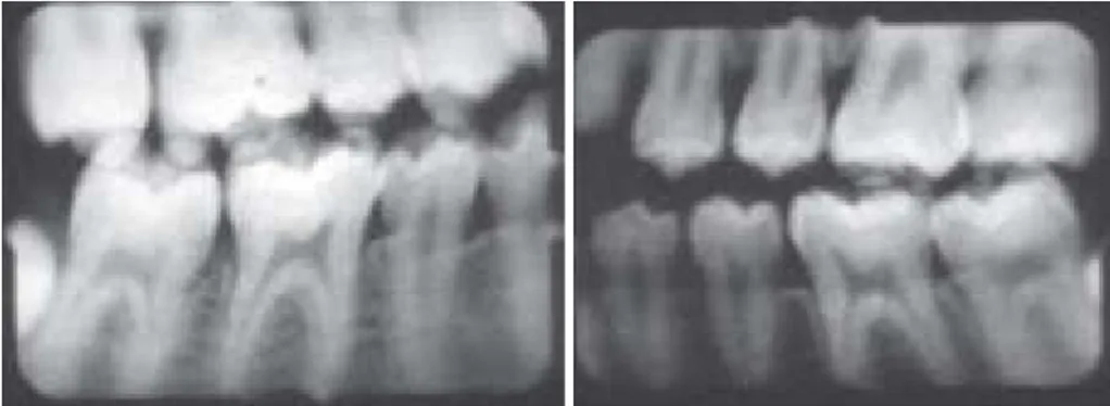 Gambar 2.2 Radiografi bitewing