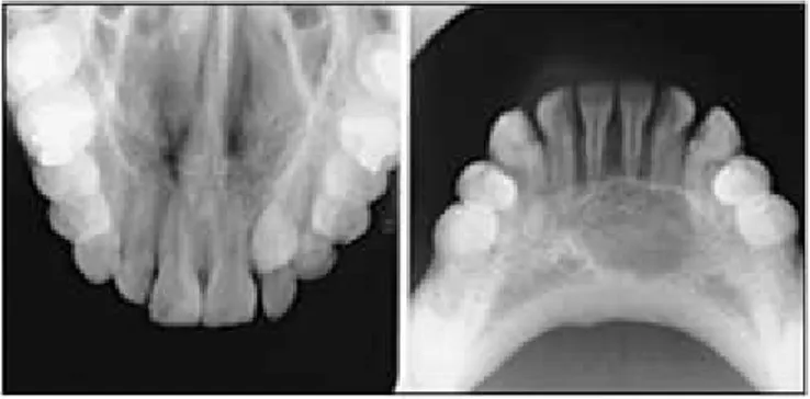 Gambar 2.3 Radiografi Oklusal (Allan G. Farman, 2014) 2.3.2 Radiografi Ekstra Oral