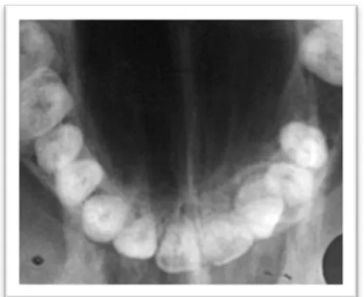 Gambar 2. Hasil radiografi  oklusal 12