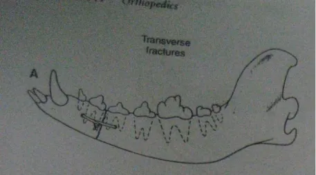Gambar 5. Cara pemasangan bone wire tunggal  