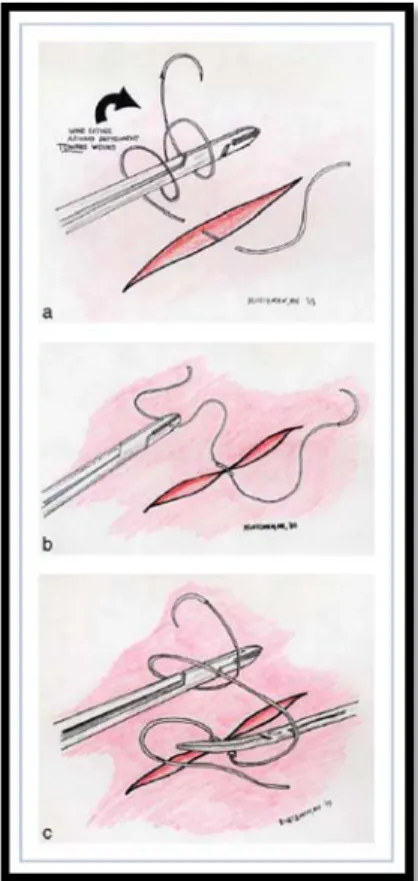 Gambar 11. Surgeon’s knot 14
