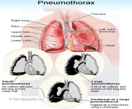 Gambar 1.1 Pneumothorax 