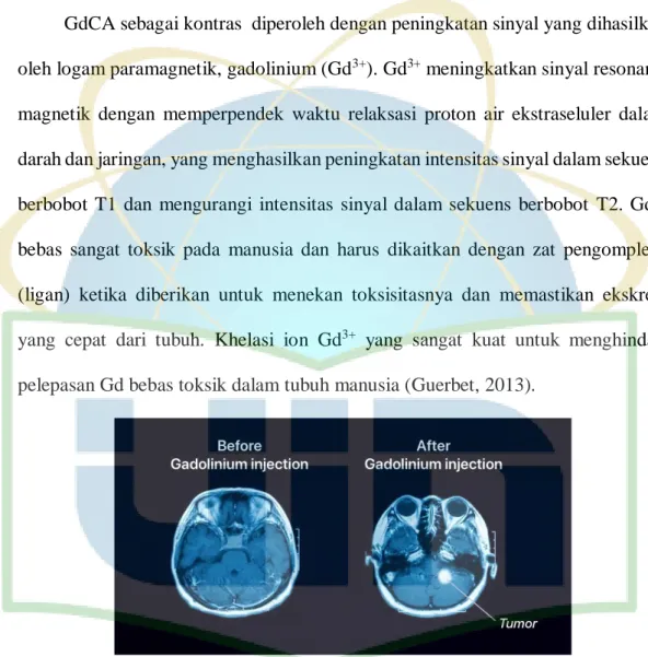 Gambar 5. Gadolinium digunakan pada pemindaian MRI   (Inside Radiology, 2020). 