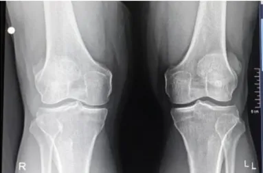 Gambar 2. Radiograf knee joint proyeksi Lateral Kanan dan Kiri  Hasil ekspertasi dokter radiolog 