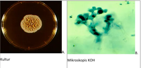 Gambar 2.7: A. Gambaran Kultur Trichophyton schoenleinii dan   B. Gambaran Mikroskopis KOH Trichophyton schoenleinii