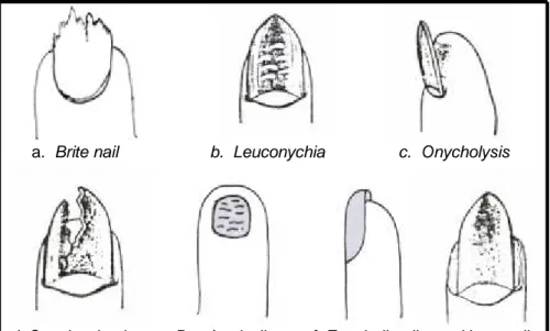 Gambar 1.3  Kelainan-kelainan pada Kuku  3)  Bentuk Kuku 